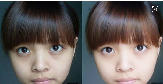 黑眼圈怎么治疗