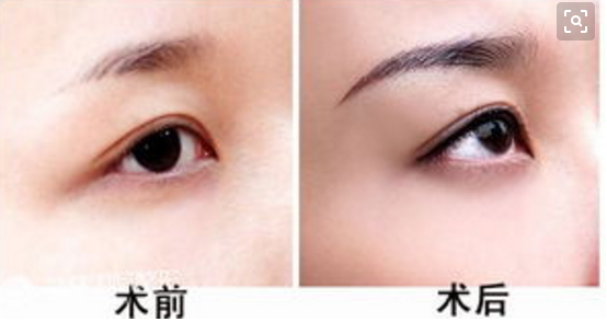 切眉毛多少钱