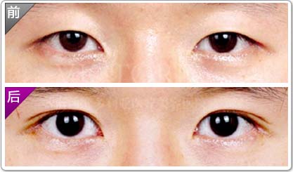 南京埋线双眼皮需要多少钱