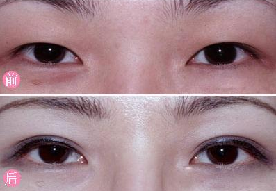 韩式割双眼皮多少钱,韩式割双眼皮价格多少，韩式割双眼皮手术的费用