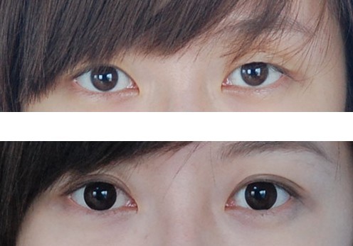 埋线双眼皮手术哪里好,埋线双眼皮手术哪里最好,埋线双眼皮的三大优势