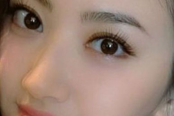 眼袋与卧蚕有哪些区别