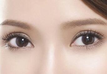 埋线双眼皮手术术后效果能维持多久