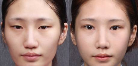 韩式三点双眼皮多少钱,韩式三点双眼皮的特点,切开双眼皮手术
