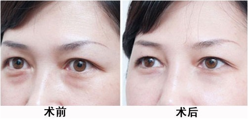 吸脂去眼袋 