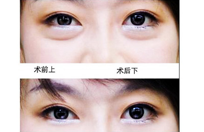 无痕去眼袋手术 