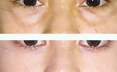 内切去眼袋,内切去眼袋的优点,内切去眼袋手术方法