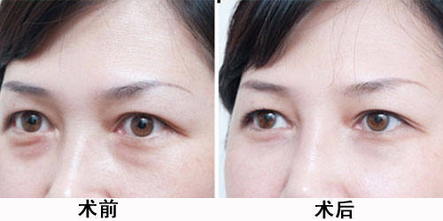 超声波去眼袋多少钱