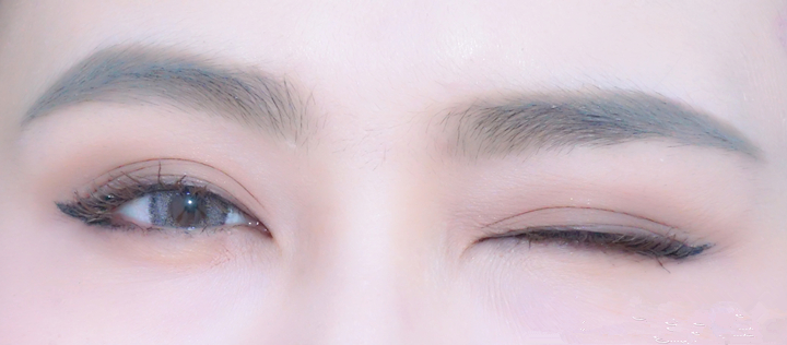 埋线双眼皮手术