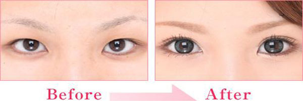 埋线双眼皮消肿