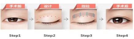 韩式眼部综合整形