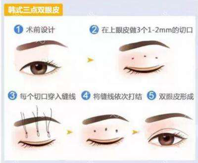 韩式定点双眼皮