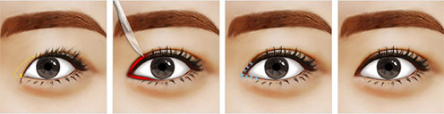 开内眼角过程图