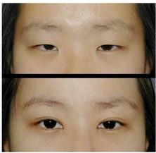 韩式双眼皮术多少钱？赶紧来看看吧！