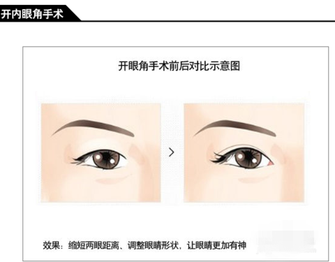 开内眼角有几种方法？答案在这里