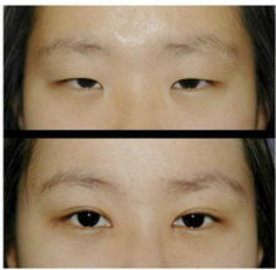 韩式双眼皮手术对比照片 赶紧围观！