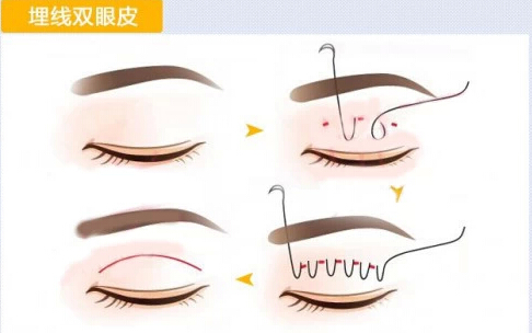埋线双眼皮——不开刀的双眼皮！