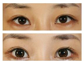 哪些人适合做开眼角手术