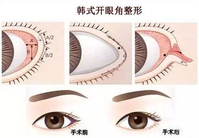 韩式开眼角整形优势