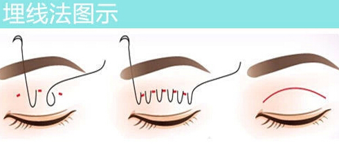 埋线双眼皮