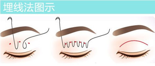 高分子双眼皮其实就是埋线双眼皮？