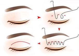 埋线双眼皮可以维持多久？