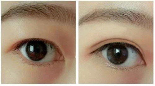  埋线双眼皮与切开双眼皮哪个好