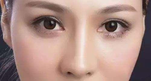 修复切开双眼皮恢复时间