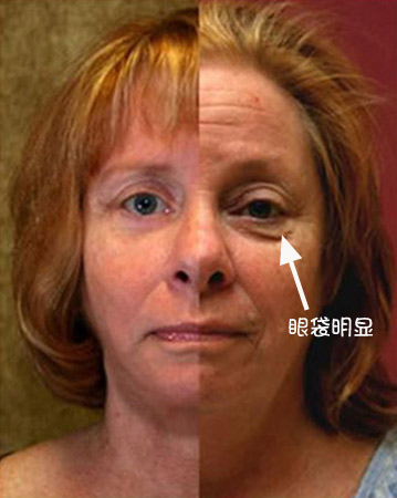 有无眼袋的区别