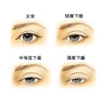 上眼睑下垂矫正方法