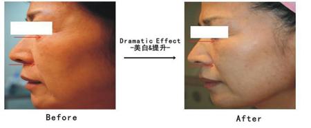 韩式射频点阵御肤术对比图