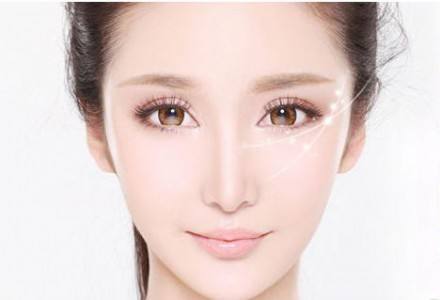 埋线双眼皮失败