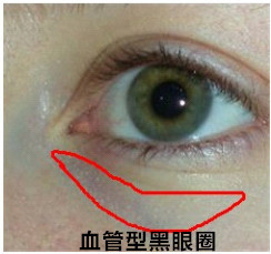 血管型黑眼圈