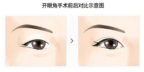 开眼角前后对比图
