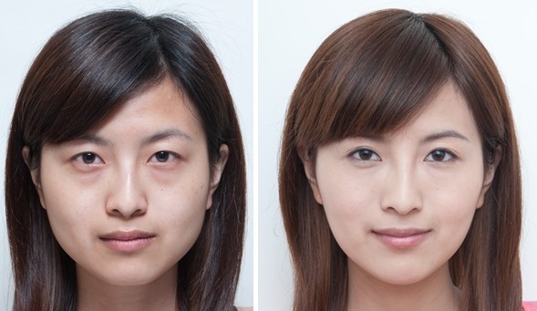 无痕去眼袋多少钱