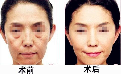 激光去眼袋的价格