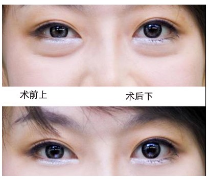 去眼袋手术多少钱啊