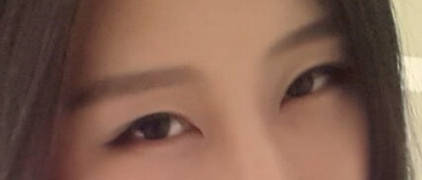 内双美女不愿再贴双眼皮贴 毅然做切开双眼皮术1