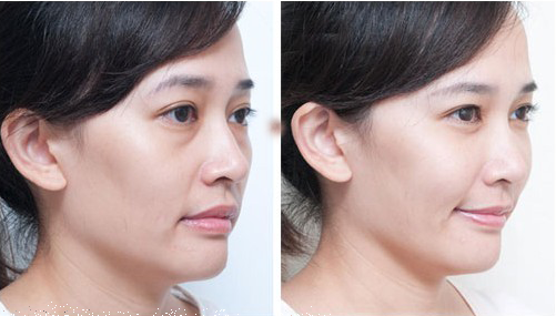 祛眼袋的有效方法