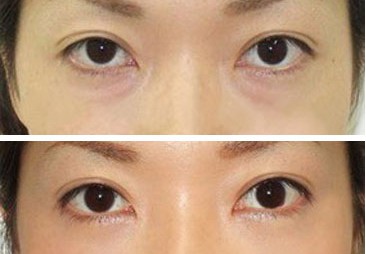 去眼袋手术多少钱啊 