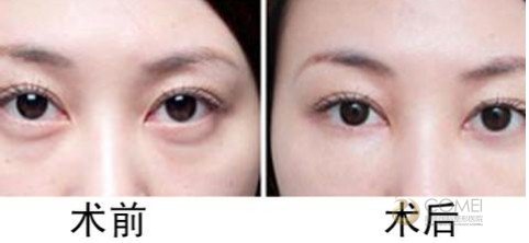 做完外切去眼袋手术多久能化妆  