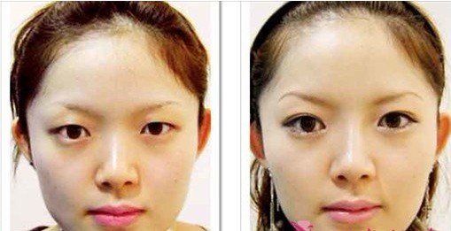 割双眼皮手术要多少钱   