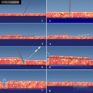 台湾埋线拉皮原理