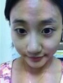 　网友“时籍暖度”术前样子