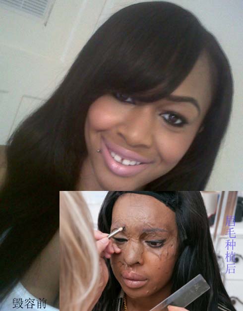 21岁女孩因酸袭击毁容 眉毛移植术让她重获新生