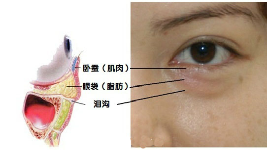 泪沟眼袋卧蚕怎么区分