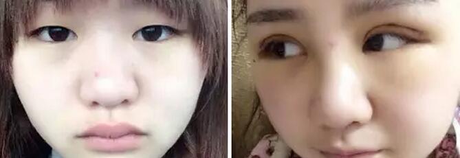 埋线双眼皮手术恢复