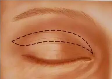 切开双眼皮手术中如何抽脂