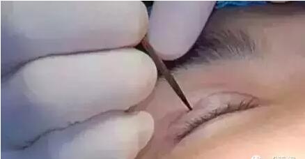 双眼皮手术埋线法是怎么做的