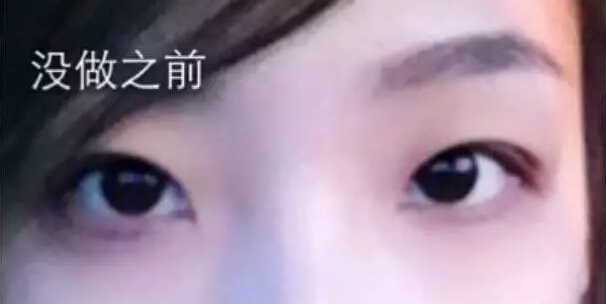 开眼角什么时候能好？来看网友实例皂片